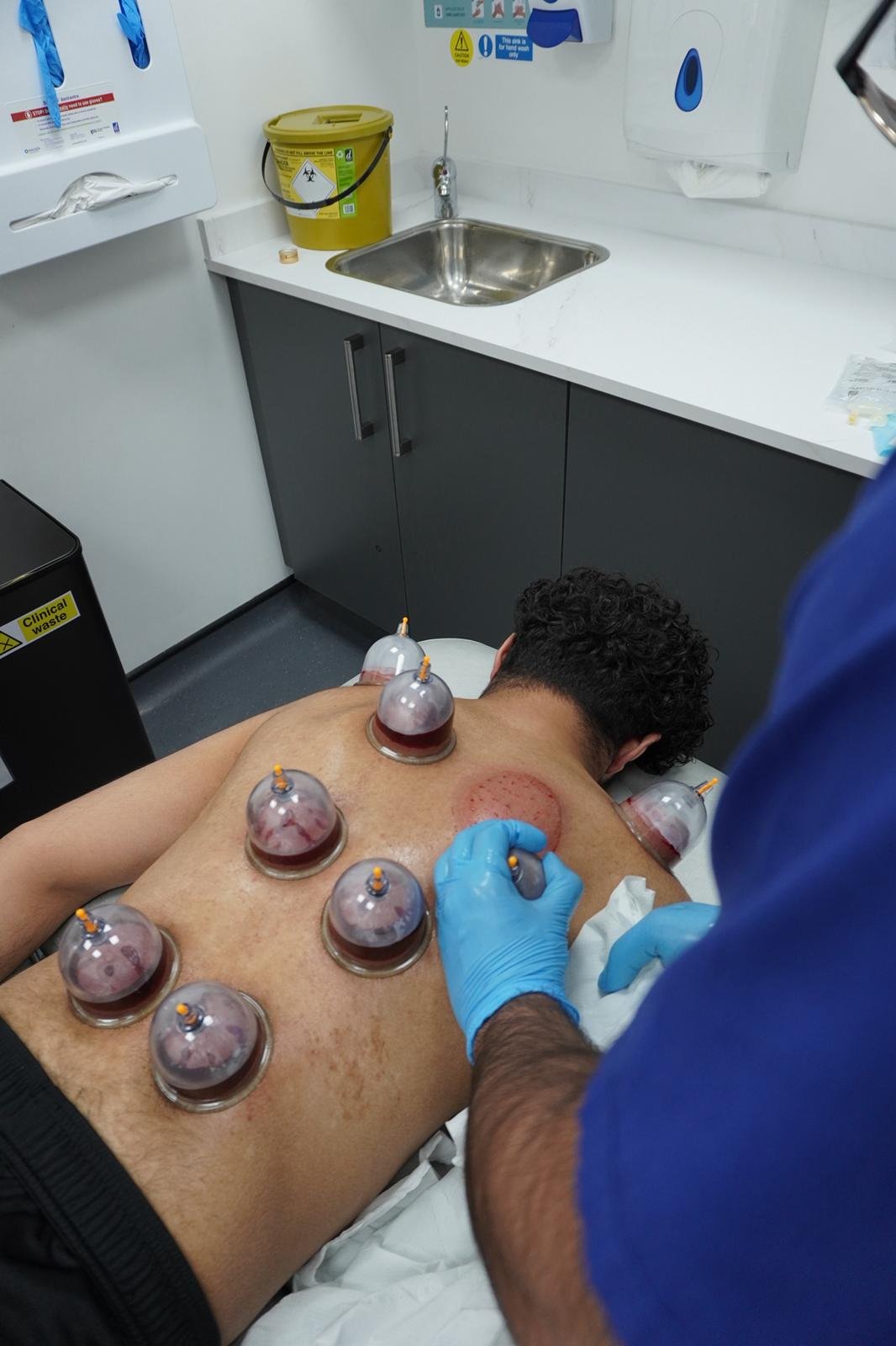 Hijama (cupping) therapy session at Sadiqi Medical Centre in Leyton, East London